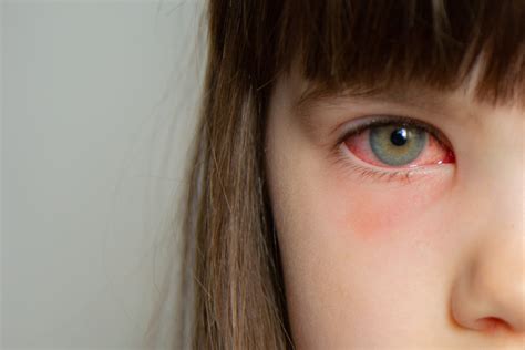 Niños y ojos rojos: la principal causa es la conjuntivitis