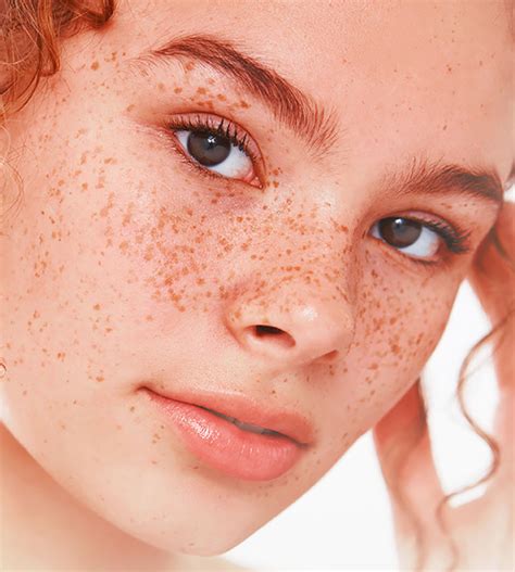 Everything You Need to Know about Hyperpigmentation