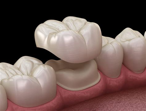 Complete Dental Crown Guide: Cost, Procedures, And Types