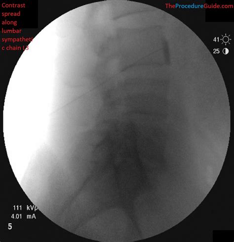 Lumbar Sympathetic Block - Technique and Overview - The Procedure Guide