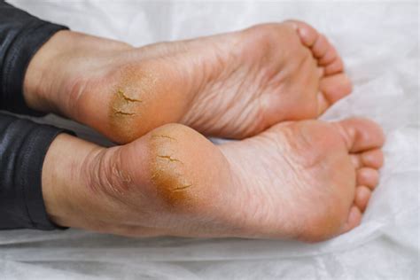 Foot Fissures – Symptoms, Causes, Treatment, Prevention & Remedies