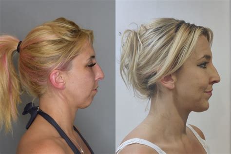 Chin Lipo Before and After: The Anatomy - Best Chin Lipo Results