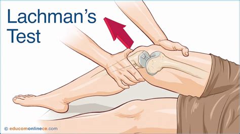 Anterior Cruciate Ligament (ACL) Injuries – Core EM