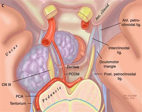 Pituitary Tumor Symptoms