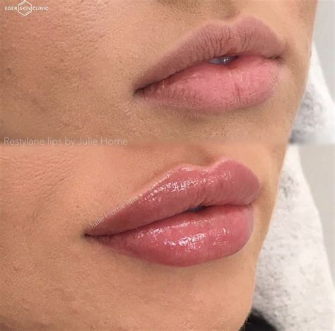 Pin by melody on pretty lips | Botox lips, Lips inspiration, Lip fillers