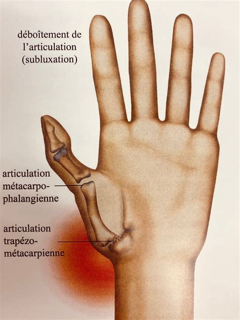 Rhizarthrose, l’arthrose du pouce | Elsan