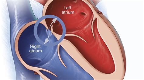 Mayo Clinic Q and A: Treatment for patent foramen ovale - Mayo Clinic ...