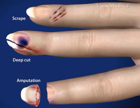 How To Know If Your Nail Bed Is Damaged - Bed Western