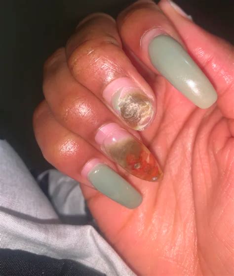 What Causes Fungus to Grow Under Acrylic Nails, and How Do You Treat It? | BLAC Detroit