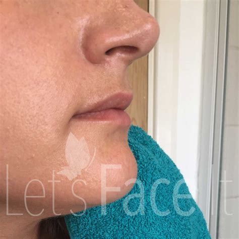 Lip Fillers - Hoddesdon - Anti Wrinkle Treatments & Dermal Fillers - Lets Face it