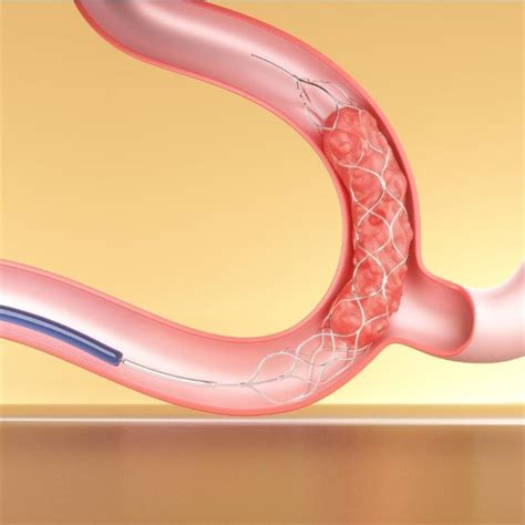 Neurovascular Thrombectomy Devices