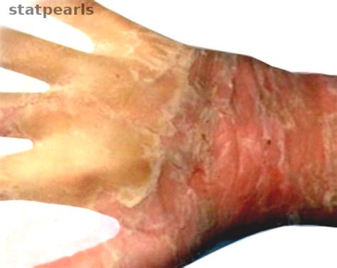 Epidermolytic Hyperkeratosis | Treatment & Management | Point of Care