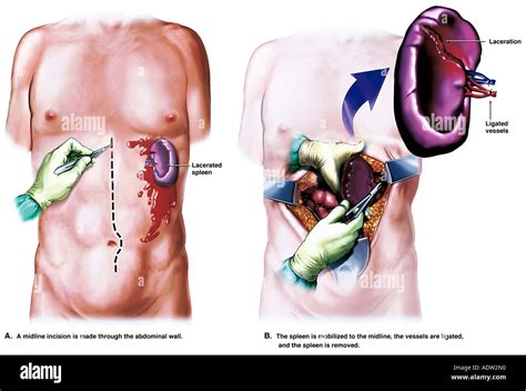 Surgical Splenectomy Procedure Stock Photo, Royalty Free Image: 7711439 - Alamy