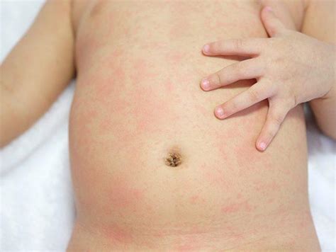 Roseola In Toddlers: Causes, Symptoms And Treatment