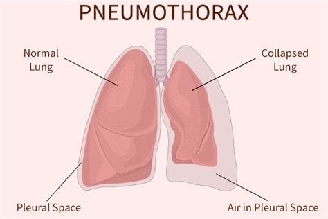 Pneumothorax (Collapsed Lung): Causes & How to Treat It