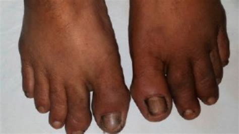 Psoriatic Arthritis Toes