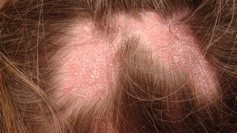Red Spots On Scalp And Hair Loss - vrogue.co