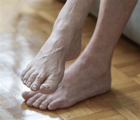 Collection 92+ Pictures Photos Of Arthritis In Feet Full HD, 2k, 4k