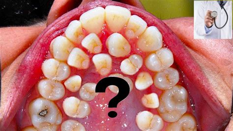 Supernumerary Teeth Hyperdontia – Telegraph