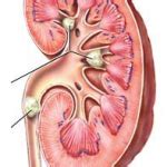 Urinary Tract Stones | Symptoms and Treatment of Kidney Stone