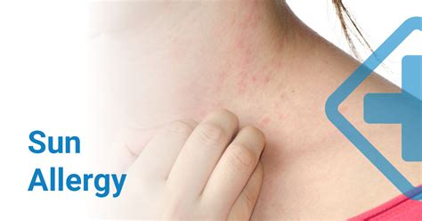 Sun Allergy? Here’s what you need to know!