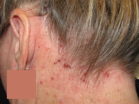 Eczema Atopic Dermatitis Symptoms Causes Treatment An - vrogue.co