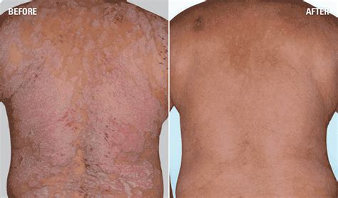 Psoriasis Before & After Pictures | SKYRIZI® (risankizumab‐rzaa)