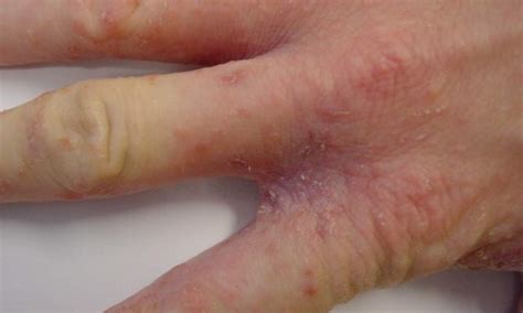 Scabies Pictures Rash Resource Scabies Rashes Scabies - vrogue.co