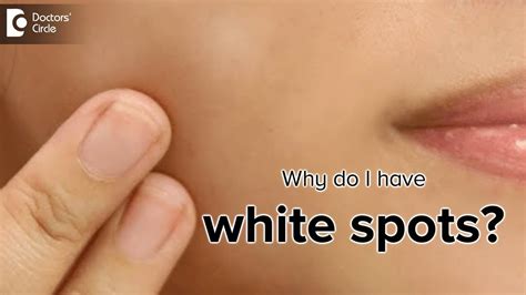 What is the cause of white spots on the skin? - Dr. Rasya Dixit - YouTube