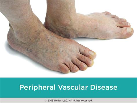 Pad Symptoms Complications Vascular Peripheral Artery - vrogue.co