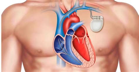 Pacemaker Implantation: Types, when advised, surgery procedure, post-procedure care