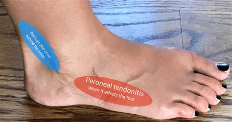 What is that pain on the outside of my foot? - Almawi Limited The ...