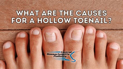 What are the causes for a hollow toenail?: Central Massachusetts ...