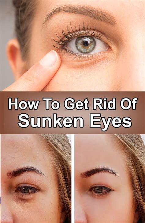 How To Get Rid Of Sunken Eyes | Sunken eyes, How to get rid, Eyes