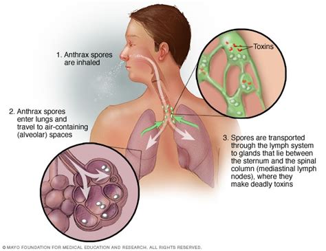 Anthrax - Symptoms & causes - Mayo Clinic