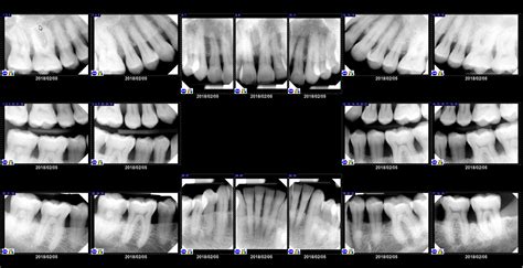 Dental X-rays: Why, Which, & When? - Digital X-rays - Charlotte dentist