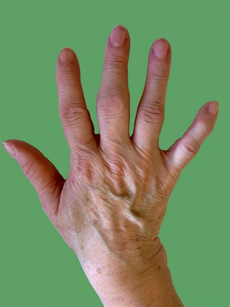 Osteoarthritis Hands