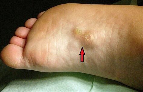 Plantar Fibroma Pictures Treatment Surgery Symptoms