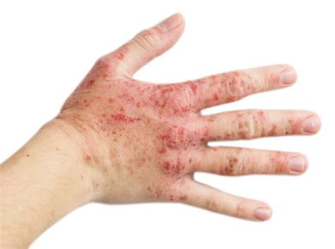 Guttate psoriasis: causes and natural treatment - Health Wages