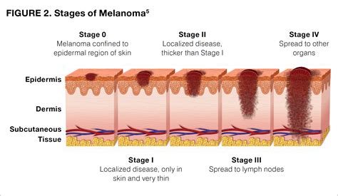 Melanoma pictures by stages, stage 0-1-2-3-4 melanoma pictures, melanoma in situ picture ...