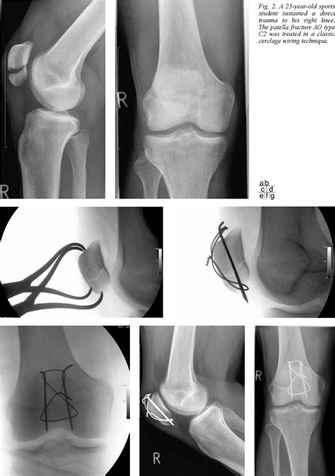 [PDF] Patellar fractures--a review of classification, genesis and evaluation of treatment ...