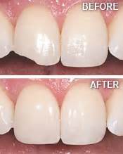 Cosmetic Resin Bonding | Advanced Dentistry | San Francisco CA