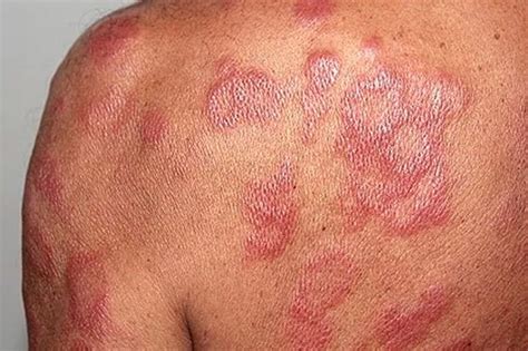 Leprosy Outbreak in Florida: Symptoms, Causes, and Treatment - Weekly ...