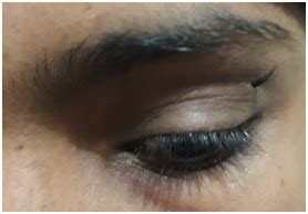 Ectopic Eyelid Cilia in a 15 years old Girl: A Rare Presentation | Journal of Lumbini Medical ...