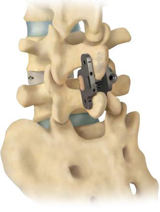 The Aspen MIS Spinous Process Fusion System | IntechOpen