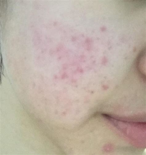 [acne] Red scars/marks that just will not fade? : r/SkincareAddiction