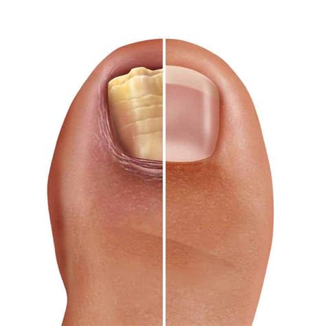 Curing Foot Rot: A Comprehensive Guide | My Foot Dr