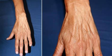 Hand Vein Causes & Treatments - San Diego Cardiac Vein and Laser Center