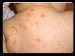 Details more than 71 scabies and tattoos latest - thtantai2