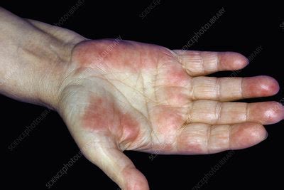 Neutrophilic dermatosis in Sweet's disease - Stock Image - C048/6273 - Science Photo Library